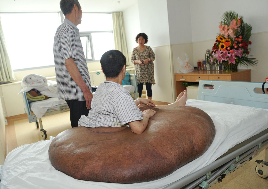 Mężczyzna z gigantycznym guzem! Narośl ważyła 107 kilogramów!