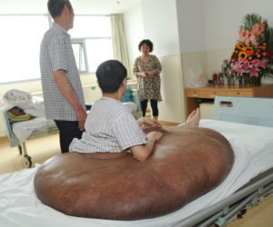 Mężczyzna z gigantycznym guzem! Narośl ważyła 107 kilogramów!