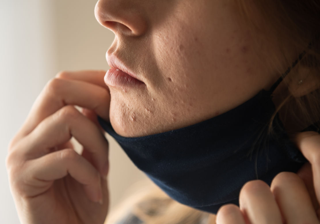 Wzmożone wydzielanie sebum i zaostrzenie trądziku
