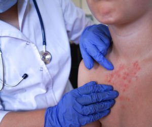 Ten kraj pokonał epidemie mpox. W dwa lata odnotowano ponad dwa tysiące zgon