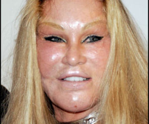 Jocelyn Wildenstein, ofiary operacji plastycznych