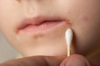 Nawracające zajady to sygnał, który wiele osób ignoruje. Prawdziwa przyczyna potrafi zaskoczyć