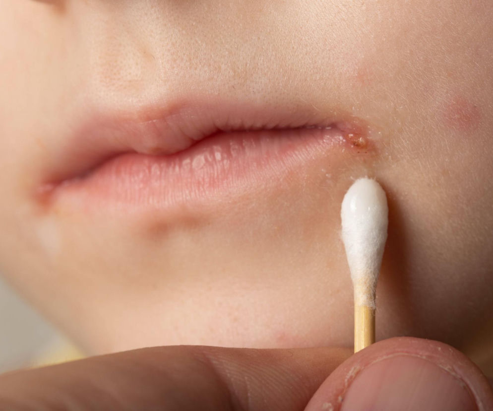 Usta z widocznymi zajadami w kącikach, na które nakładana jest maść patyczkiem kosmetycznym, symbolizują problem nawracających zajadów. To może być sygnał niedoborów lub infekcji, o czym przeczytasz więcej na portalu Poradnik Zdrowie.