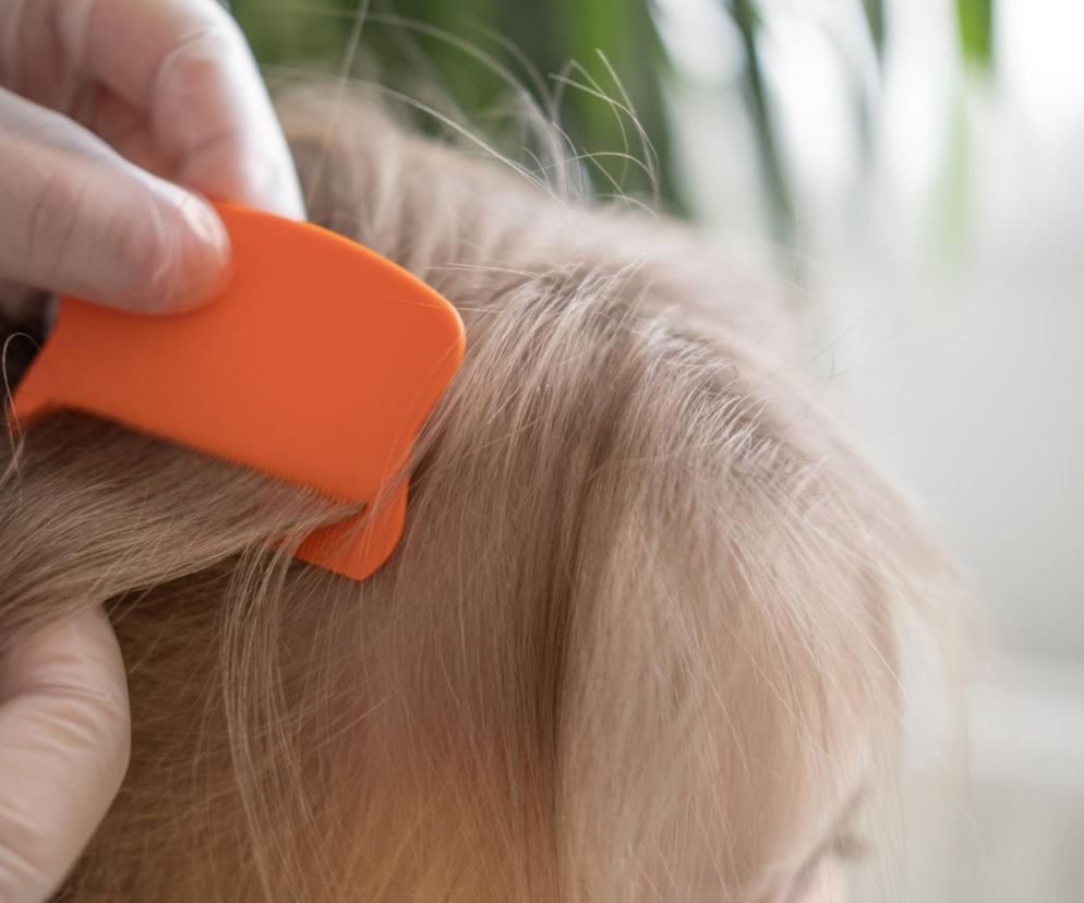 Rodzice często mylą gnidy z łupieżem. Ten prosty test rozwiewa wątpliwości