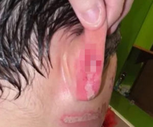 Wsadził do mikrofali plastik, eksplodował mu na twarz. 9-latek oszpecony na zawsze. Nowy niebezpieczny trend