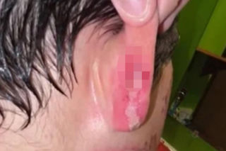 Wsadził do mikrofali plastik, eksplodował mu na twarz. 9-latek oszpecony na zawsze. Nowy niebezpieczny trend