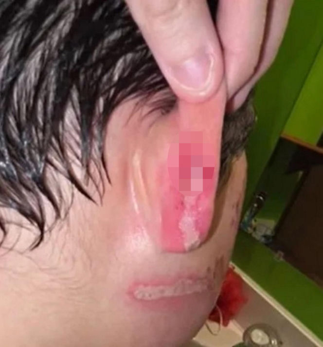 Wsadził do mikrofali plastik, eksplodował mu na twarz. 9-latek oszpecony na zawsze. Nowy niebezpieczny trend