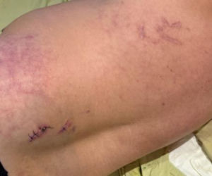 Stanął w obronie kobiety, skatowali go maczetami. Piotrek ledwo przeżył. Niemal mnie zabili