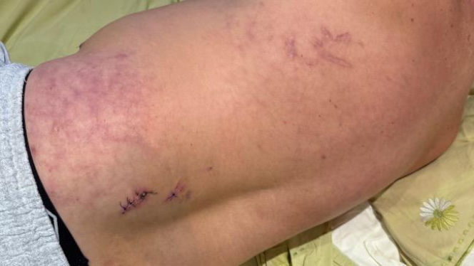 Stanął w obronie kobiety, skatowali go maczetami. Piotrek ledwo przeżył. "Niemal mnie zabili"