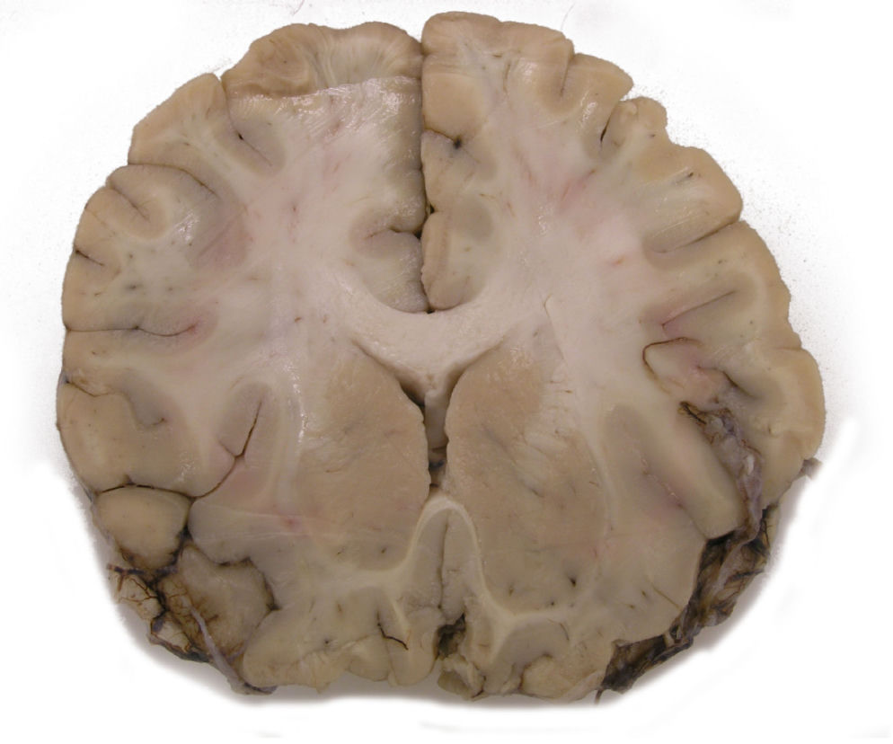 Schizofrenia - 1