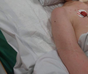 Prawie umarła przez opryszczkę