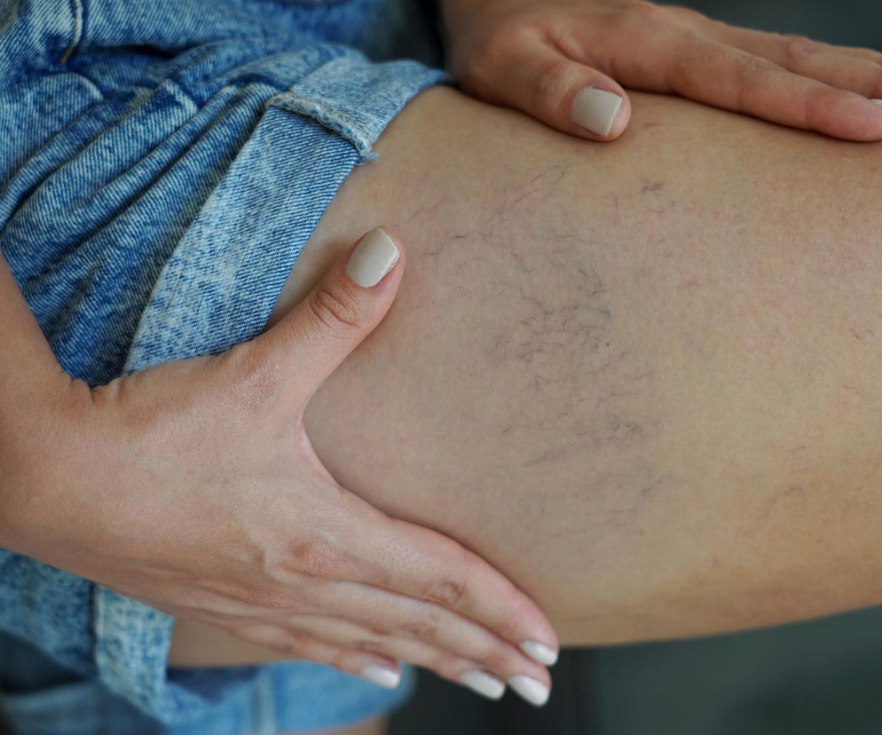 Kobiece dłonie z beżowym manicurem delikatnie dotykają uda, na którym widać wyraźne pajączki naczyniowe, zwiastujące problemy z krążeniem. O tym, że pajączki to nie tylko defekt kosmetyczny, ale sygnał alarmowy dla zdrowia, przeczytasz na Poradnik Zdrowie.