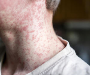 Sześć przypadków odry na Podkarpaciu. Sanepid przypomina: to nie tylko dziecięca choroba