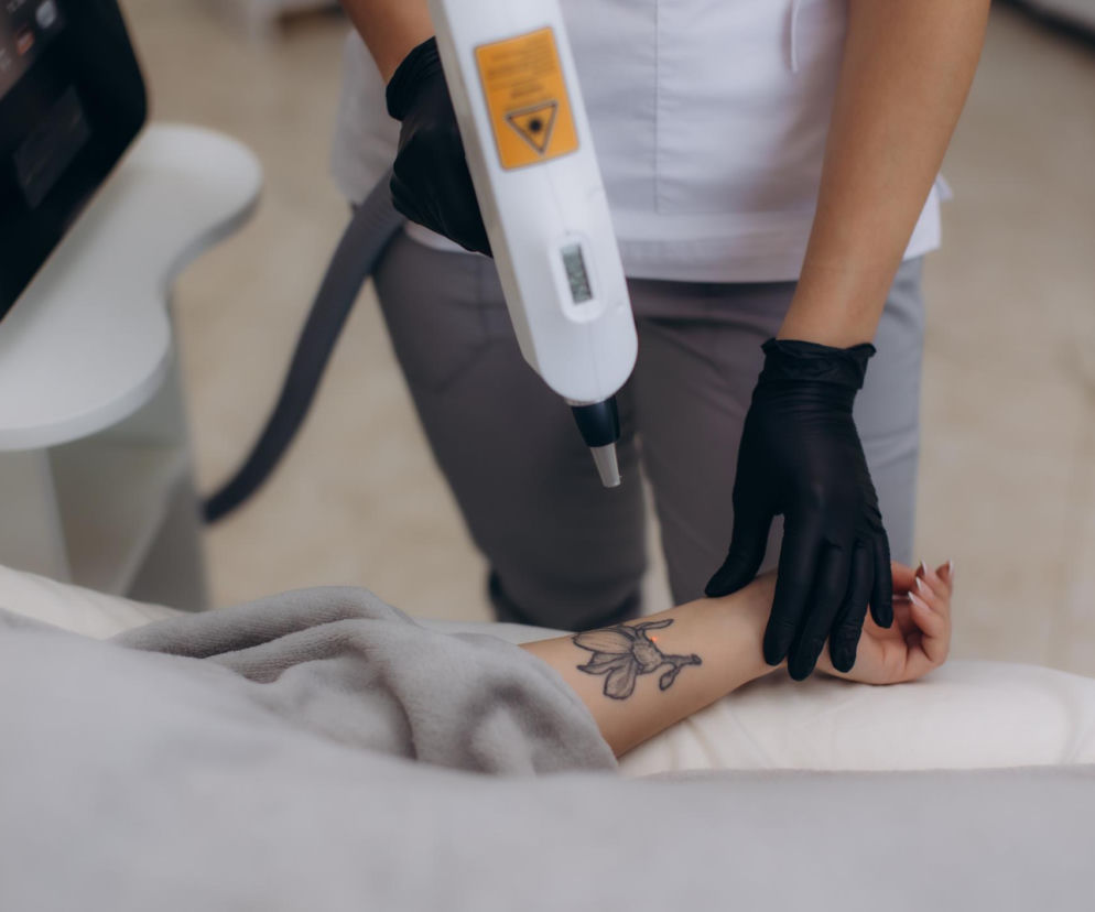 Usuwanie tatuażu laserem. Czy da się całkowicie pozbyć wzoru ze skóry?