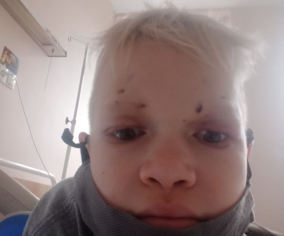 Lekarze podnieśli mu powieki