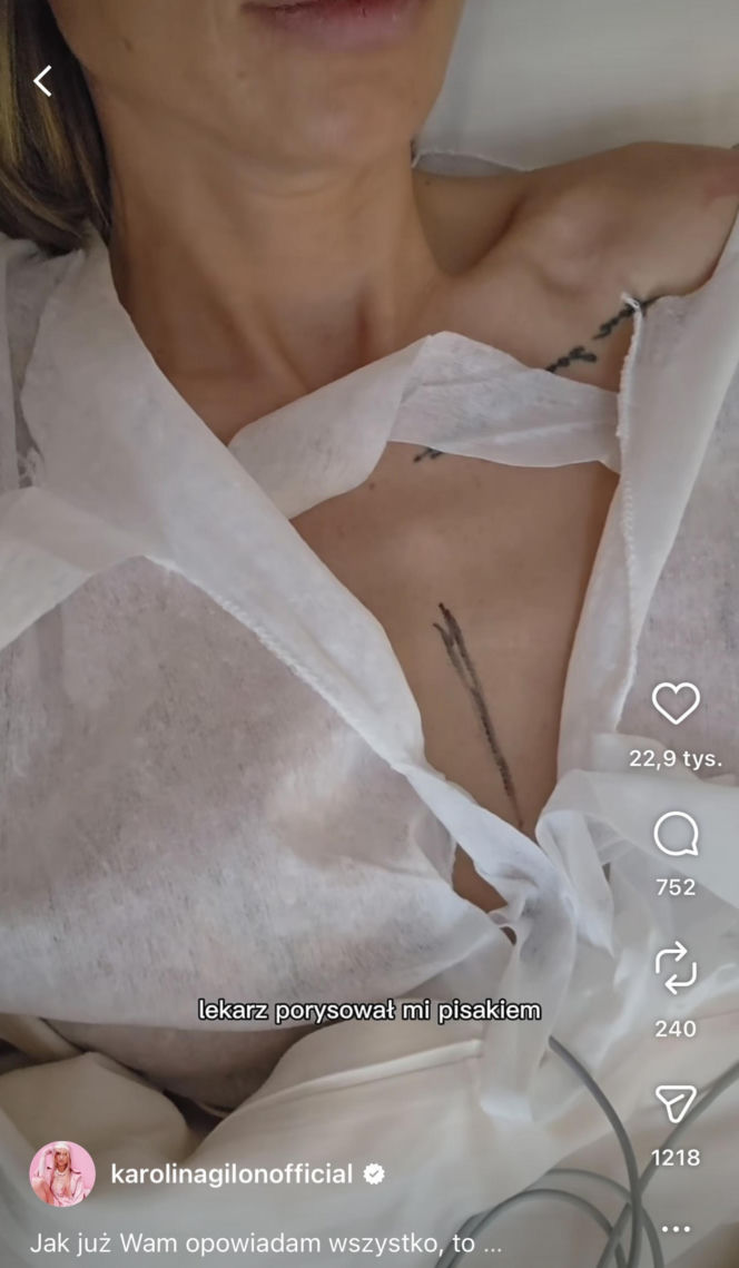 Karolina Gilon zoperowała biust. Zdjęcia przed i po
