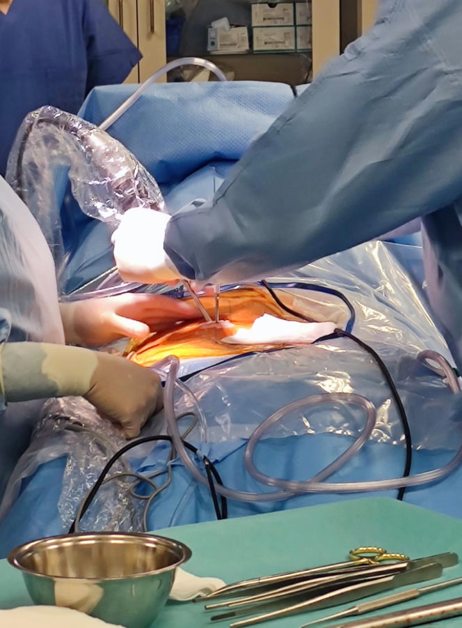 Pierwsza w Polsce operacja dyskopatii u nastolatka