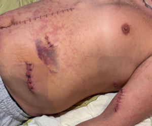 Stanął w obronie kobiety, skatowali go maczetami. Piotrek ledwo przeżył. Niemal mnie zabili