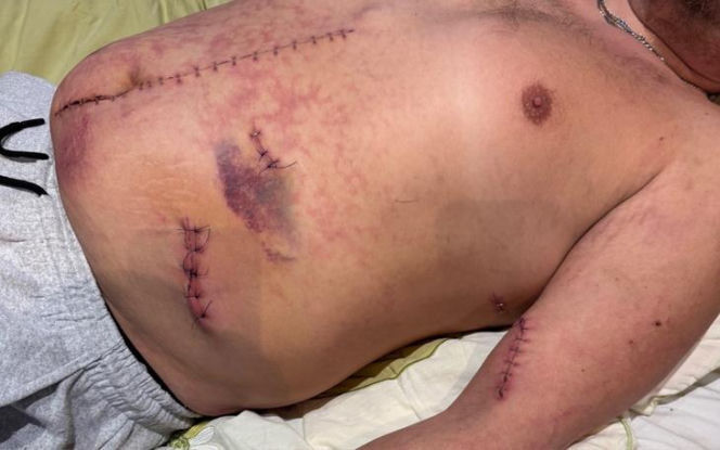 Stanął w obronie kobiety, skatowali go maczetami. Piotrek ledwo przeżył. "Niemal mnie zabili"