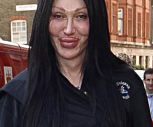 Pete Burns, ofiary operacji plastycznych