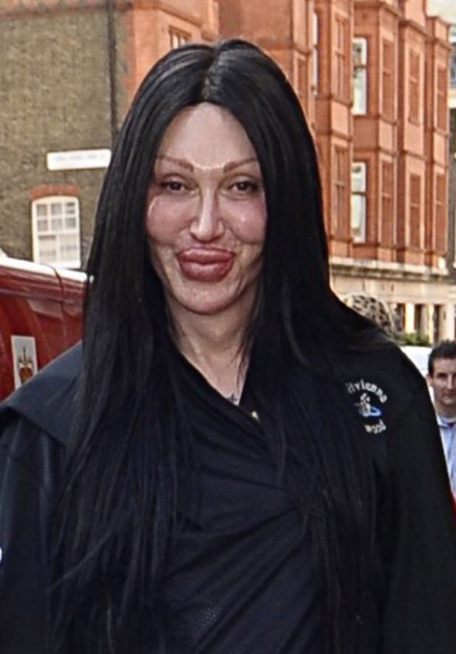 Pete Burns, ofiary operacji plastycznych