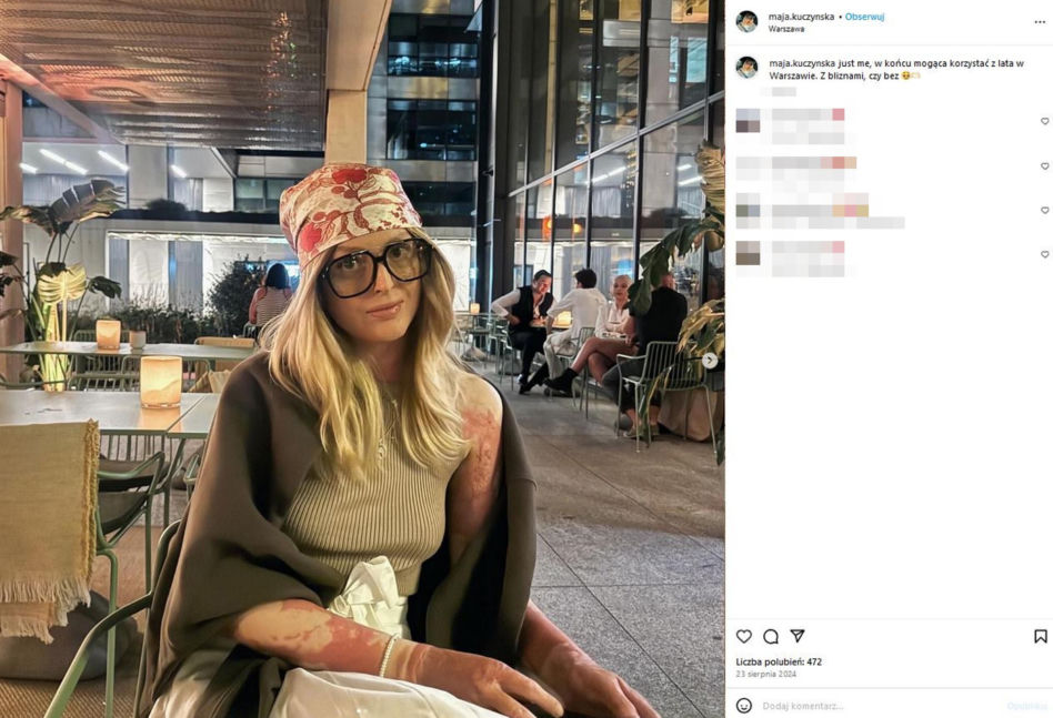 Maja Kuczyńska przeżyła piekło. Całe ciało w oparzeniach