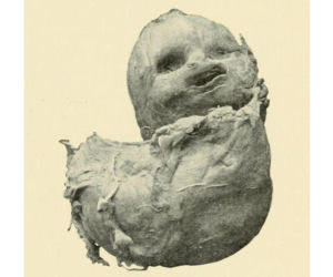 Przypadki „dzieci z kamienia” opisywano już w X wieku