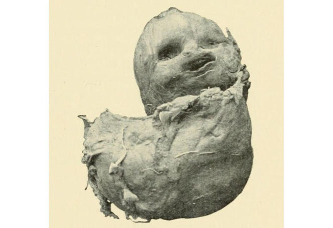 Przypadki „dzieci z kamienia” opisywano już w X wieku