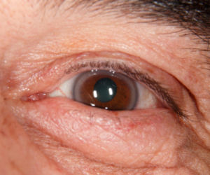 Spójrz w lustro i sprawdź tęczówki. Ta szara obwódka to nie tylko wiek, ale ważny sygnał od serca