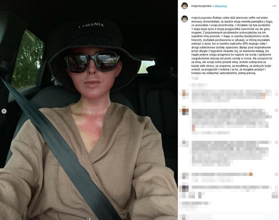 Maja Kuczyńska przeżyła piekło. Całe ciało w oparzeniach