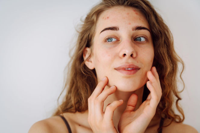 Najczęstsze mity o trądziku, które niszczą Twoją cerę. Sprawdź, co mówi nauka!