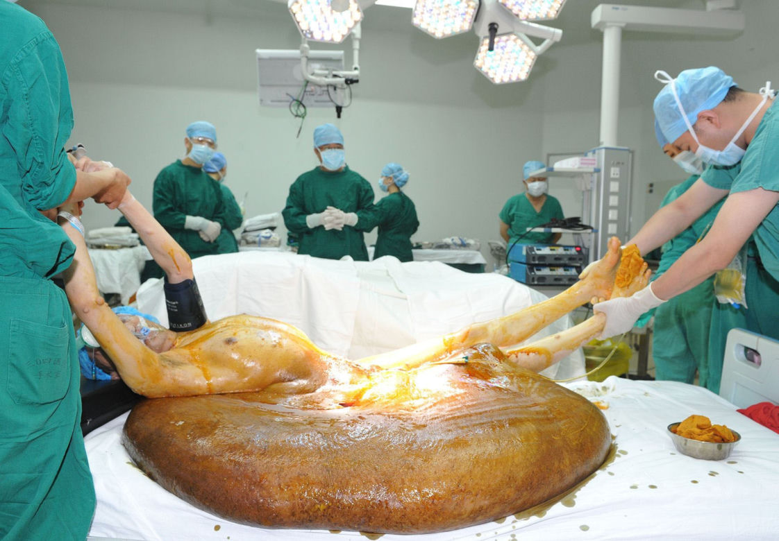 Mężczyzna z gigantycznym guzem! Narośl ważyła 107 kilogramów!