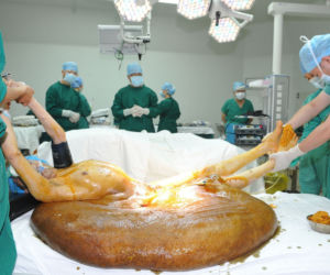 Mężczyzna z gigantycznym guzem! Narośl ważyła 107 kilogramów!