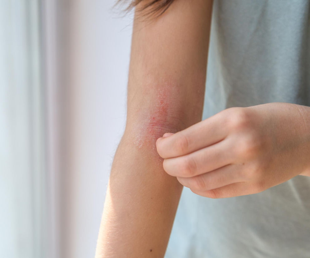 Swędzenie blizny nasila się zimą? Oto winowajca. Naukowcy wskazują prosty sposób na ulgę