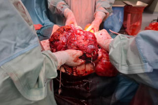 Rosło przez kilkanaście lat. Guz osiągnął monstrualne rozmiary