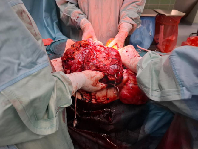 W Zagłębiowskim Centrum Onkologii usunięto gigantycznego guza