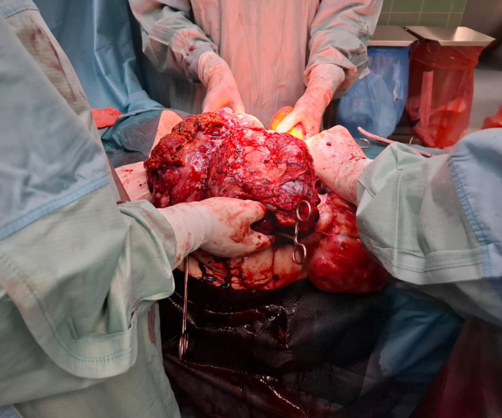 Operacja, której inni się nie podjęli. W Zagłębiowskim Centrum Onkologii usunięto gigantyczny guz