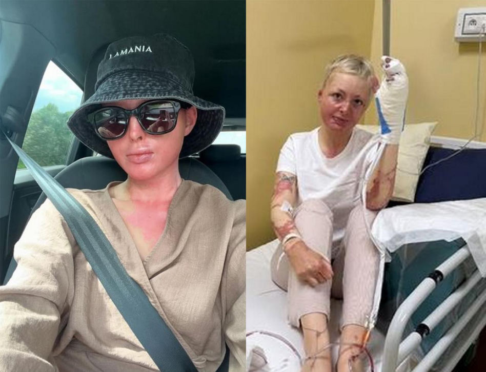 Maja Kuczyńska przeżyła piekło. Całe ciało w oparzeniach