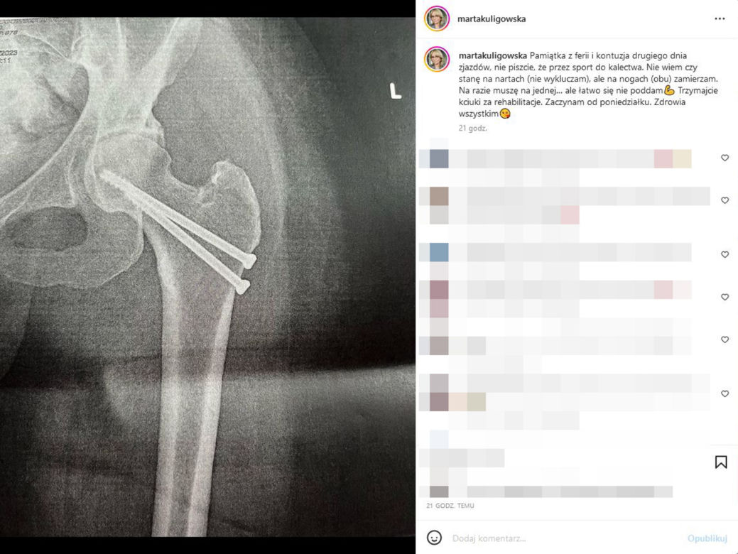 Gwiazda TVN24 miała wypadek na nartach. Marta Kuligowska musi przejść rehabilitację