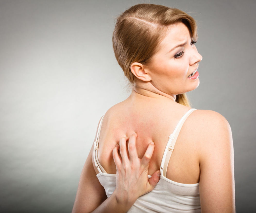 Kobieta w białym topie z intensywnym zaczerwienieniem na plecach, które energicznie drapie, odczuwając silne swędzenie. Zdjęcie ilustruje problemy skórne, takie jak wysypka czy alergia. Na Poradnik Zdrowie znajdziesz wskazówki, jak radzić sobie z suchą i swędzącą skórą.