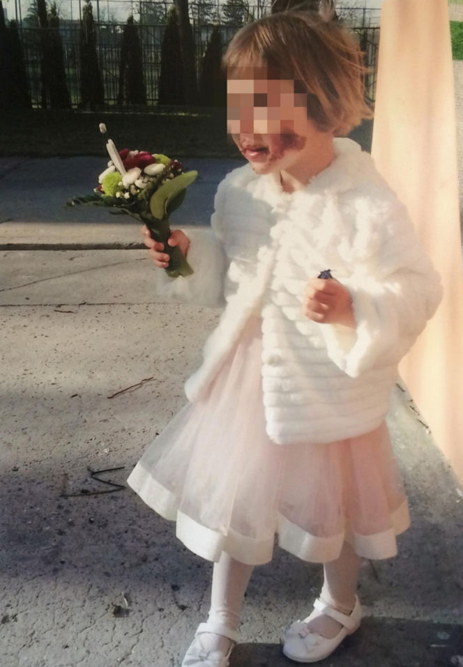 Wyrodna matka zgotowała Julce piekło. Latami wypalała jej kwasem rany na skórze!