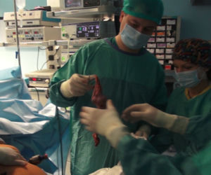 Zmniejszyli żołądek bez otwierania brzucha