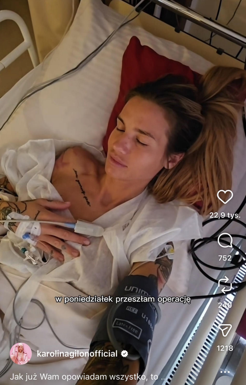 Karolina Gilon zoperowała biust. Zdjęcia przed i po