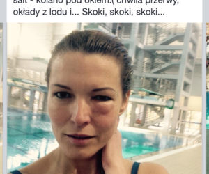 Felicjańska podbiła oko