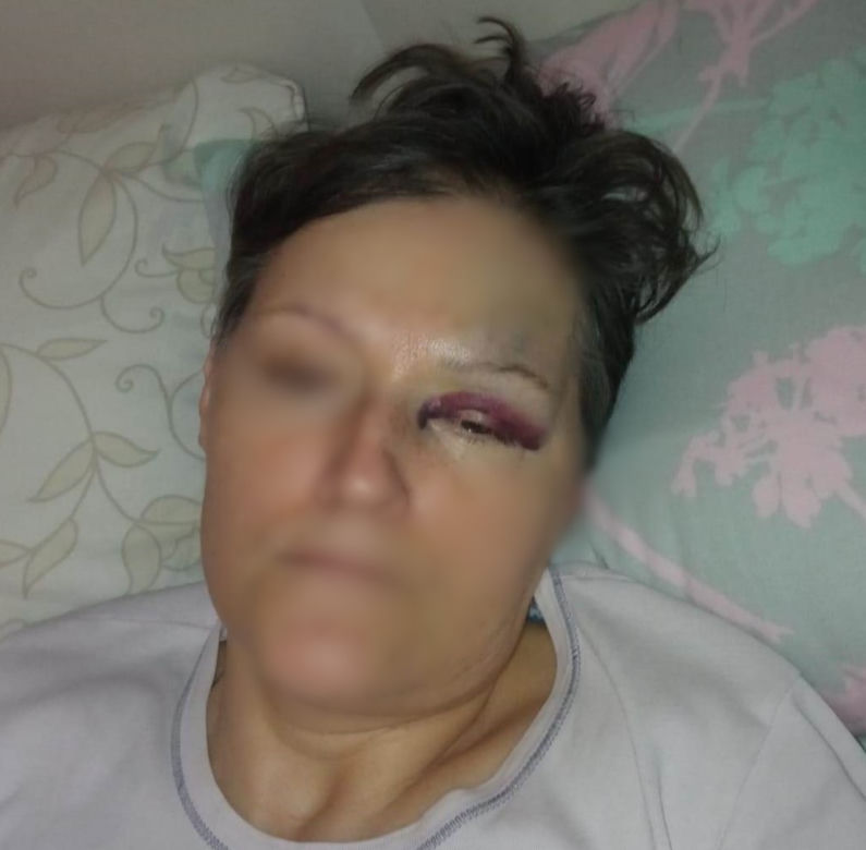 Potrącenie pieszej na pasach na rondzie santockim w Gorzowie. Poszkodowana pokazała poobijane ciało