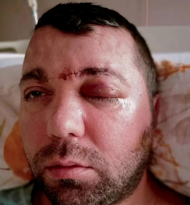 Dentysta wkręcił mi śrubę w mózg! "Zostawił mnie w szpitalu i uciekł"