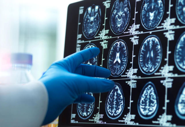 Alzheimer może być odwracalny? Przełomowe badanie z USA daje nadzieje pacjentom i ostrzega przed suplementami 