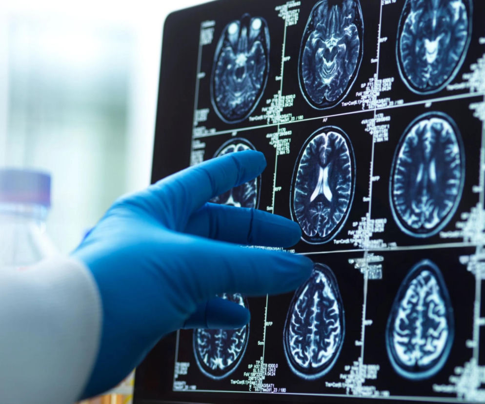 Ręka w niebieskiej rękawiczce wskazuje na ekran z badaniami rezonansu magnetycznego mózgu, które ukazują struktury wewnętrzne, sugerując analizę wyników diagnostycznych związanych z chorobą Alzheimera. O przełomowych odkryciach medycyny przeczytasz na portalu Poradnik Zdrowie.
