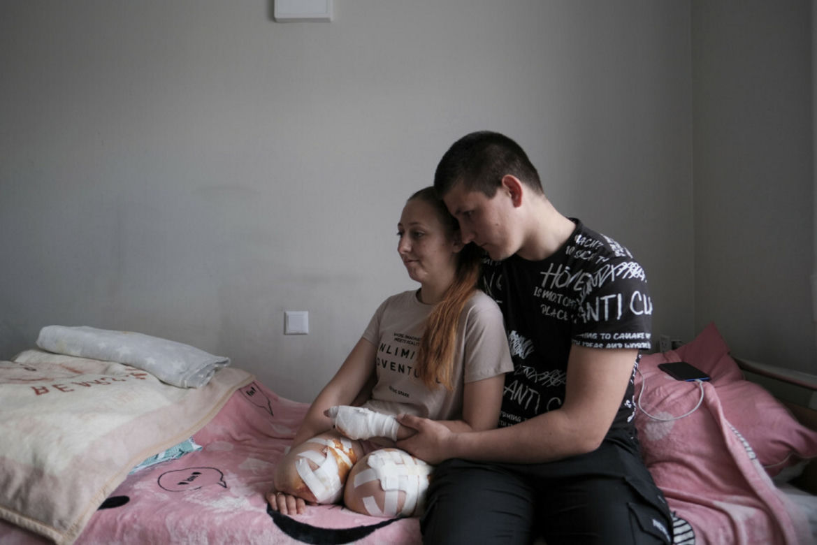 Oksana straciła obie nogi i cztery palce. Jej zdjęcia wzruszają do łez