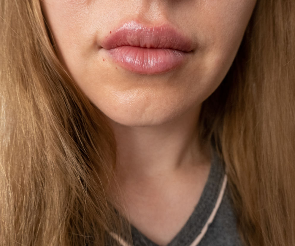 Opuchnięte usta młodej kobiety z blond włosami, widoczne zaczerwienienia po iniekcjach kwasem hialuronowym. To nietypowe powikłanie po szczepieniu na COVID-19. Więcej o tym przeczytasz na portalu Poradnik Zdrowie.